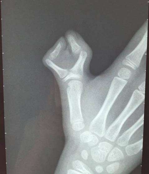 家里宝宝有多指需要注意哪些事情