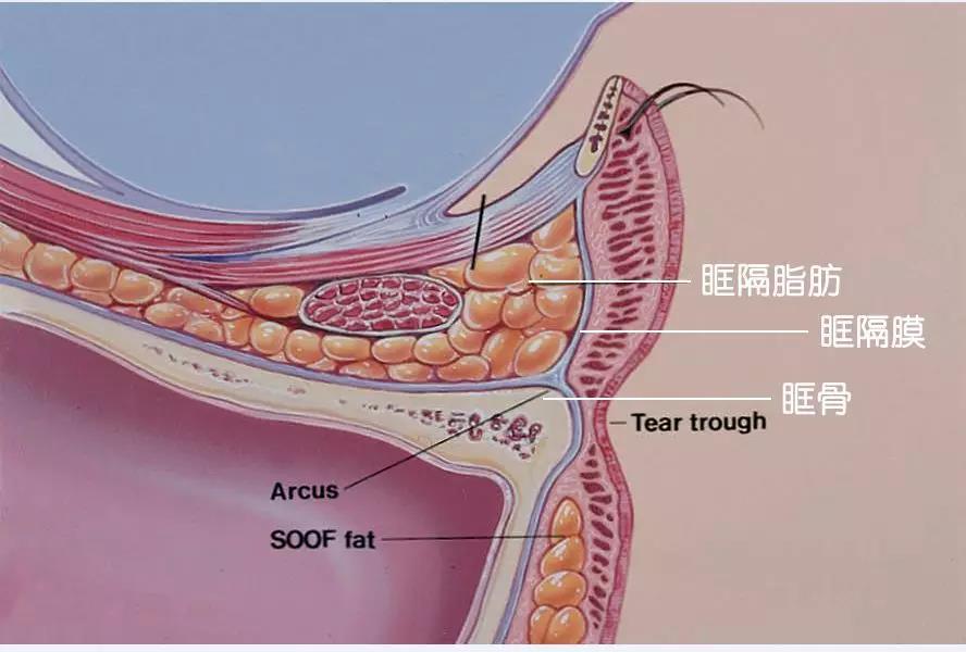 ▼眶隔脂肪释放回填后