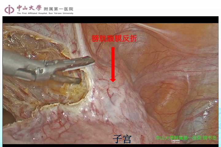 剖宫产膀胱腹膜反折图片