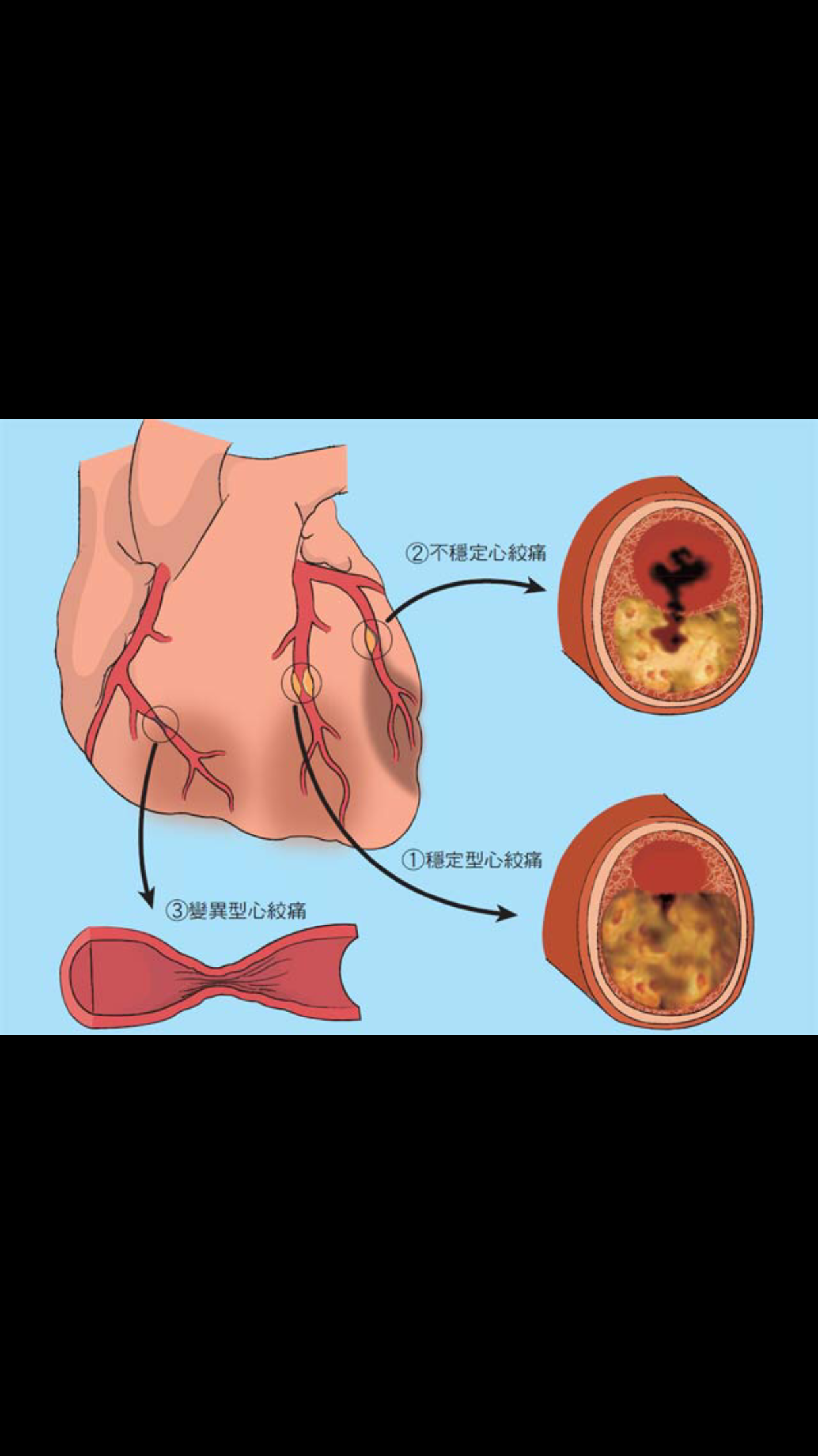 不容忽视的"心绞痛"_心绞痛_介绍_发病原因_症状表现_如何预防_治疗