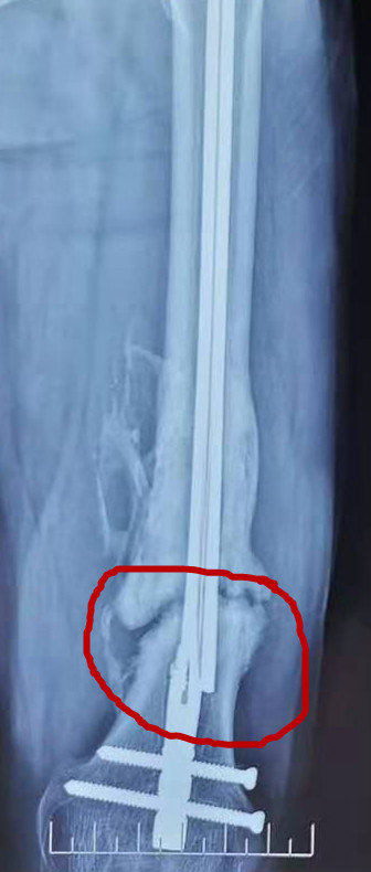 骨折手术后如何进行康复功能锻炼 骨折 好大夫在线 骨折手术后如何进行康复功能锻炼 骨折 好大夫在线