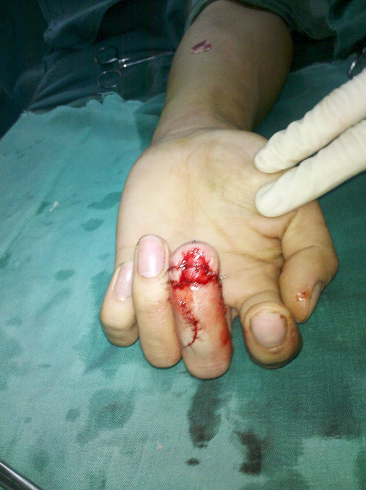 人工指甲盖植入手术图片