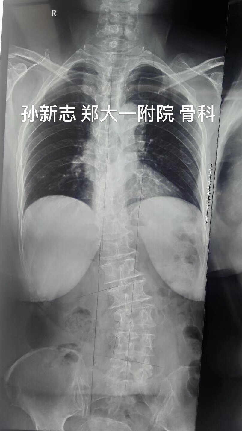 孫新志教授脊柱側彎病例3