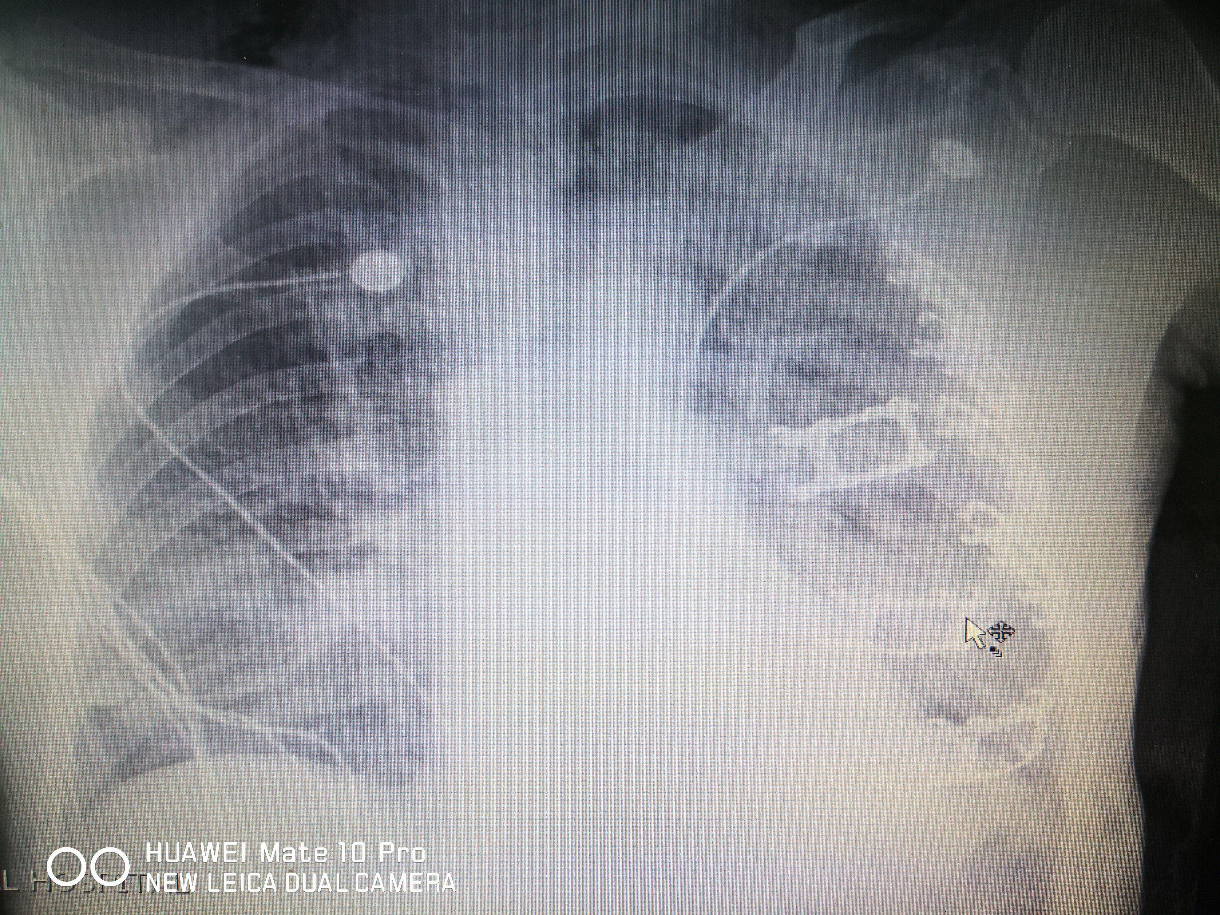 高处坠落致左侧多发肋骨骨折连枷胸并迟发性脾破裂 高处坠落致左侧多发肋骨骨折连枷胸并迟发性脾破裂