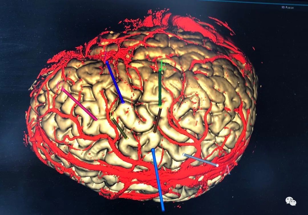 颅内深部脑电图(seeg)在难治性癫痫中的作用(ppt) - 好大夫在线