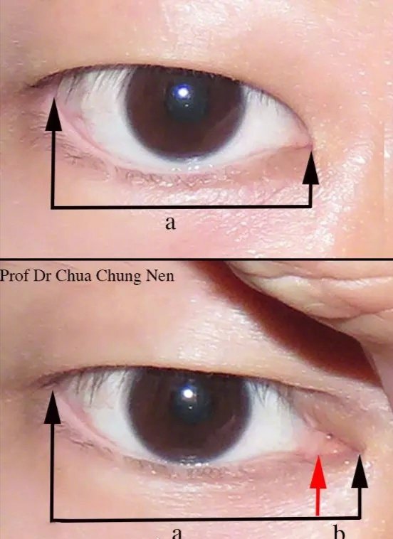 内眦赘皮又称蒙古皱襞,是指通过内眦部的纵向皮肤皱襞,常遮盖内眼角