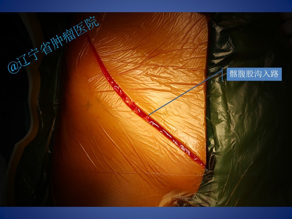 骨盆耻骨肿瘤切除手术病例 - 好大夫在线