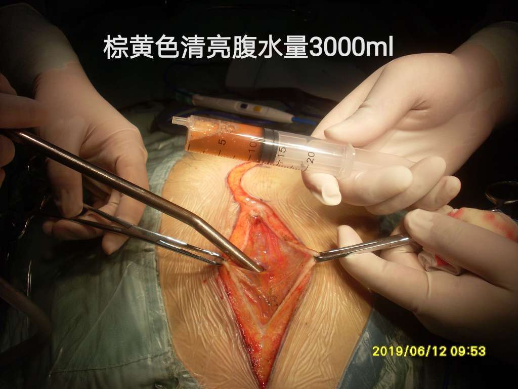 性,故决定行子宫,双附件,阑尾,大网膜切除 术中一次腹腔热灌注化疗