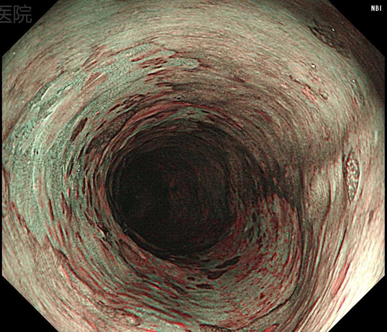 nbi 化学染色的食管早癌