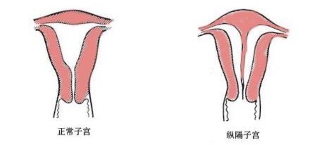 科普--子宫纵隔 - 好大夫在线