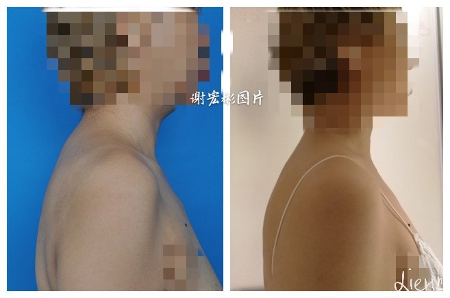 颈后脂肪垫吸脂法去除(富贵包) - 好大夫在线