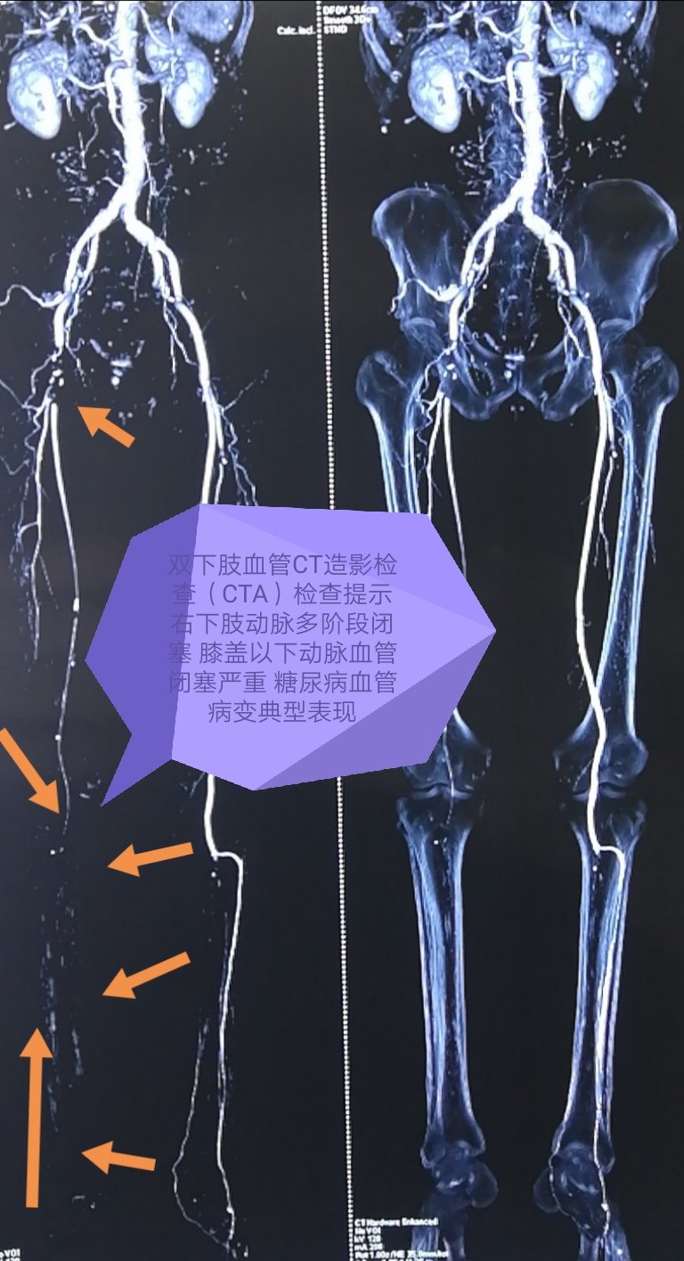 糖尿病足 溃疡 坏死 治疗经验分享 怎么让糖足患者远离截肢风险 早期自查 就诊流程 常见问题集锦 糖尿病足 预防 治疗方法 手术 病因 症状 用药