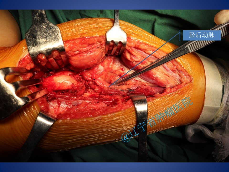 胫骨骨软骨瘤手术病例 - 好大夫在线