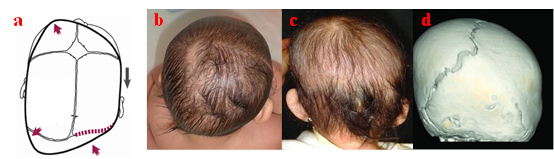 颅缝早闭 主要表现为头型异常,但人字缝早闭仍需和长期体位因素引起