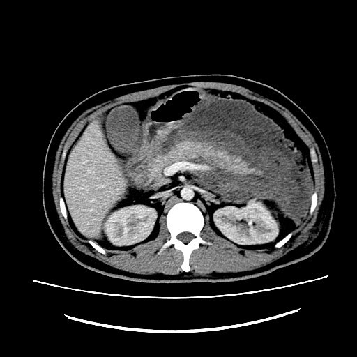 急性胰腺炎ct图片图片