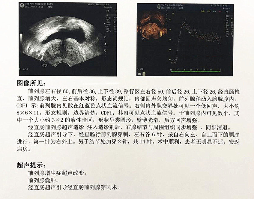 前列腺癌的早期信号图片