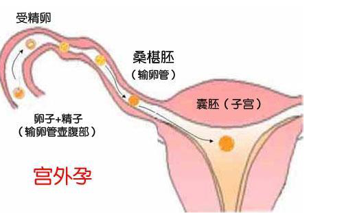 曾因輸卵管不通暢宮外孕,如今卻已迎來小公主 - 好大夫在線