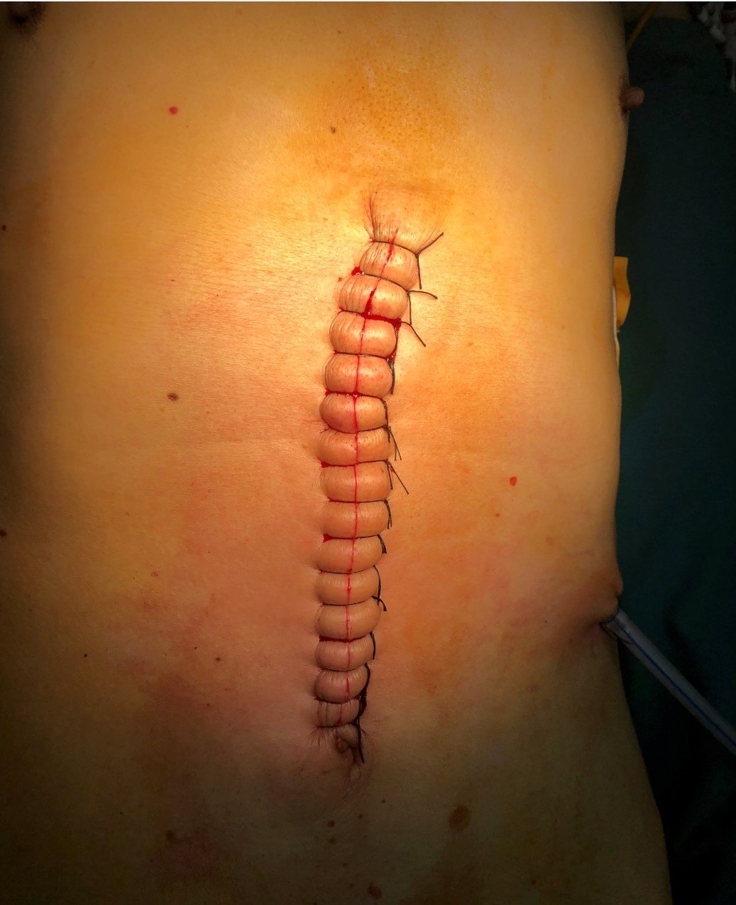 胃癌手术刀口图片图片