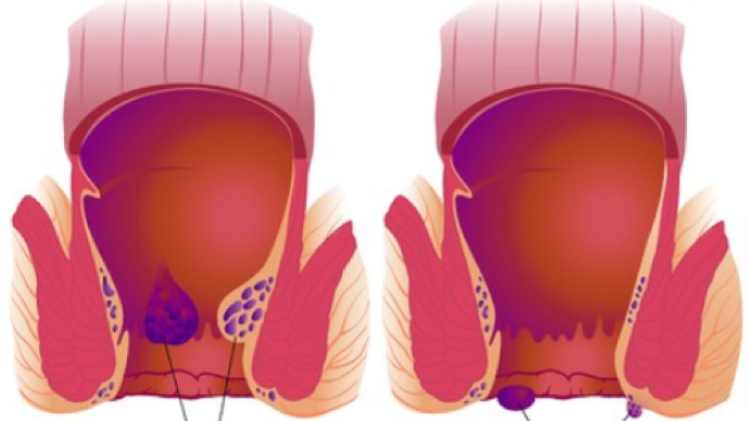 孕期長痔瘡怎麼辦,對胎兒有影響嗎?
