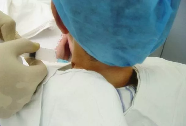 常用的神经阻滞方法有:颈椎旁的注射(就是在脖子侧边打针);椎间孔的