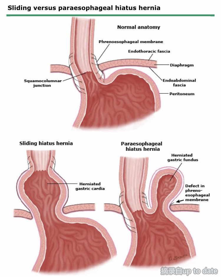 食管裂孔疝是什么病图片
