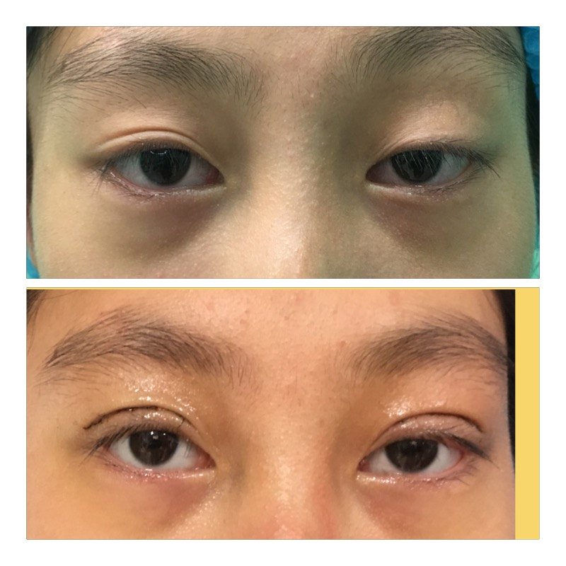 上睑下垂十双眼皮手术效果图 - 好大夫在线