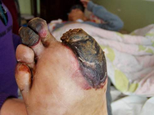 糖尿病足皮肤溃烂怎么治疗