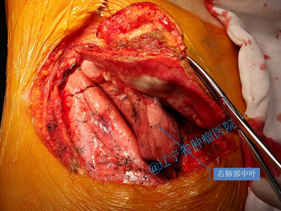 胸壁肋骨软骨肉瘤手术病例分享 