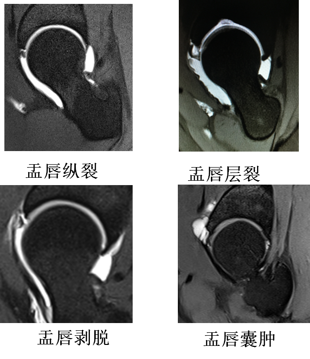 髋关节盂唇损伤的诊疗