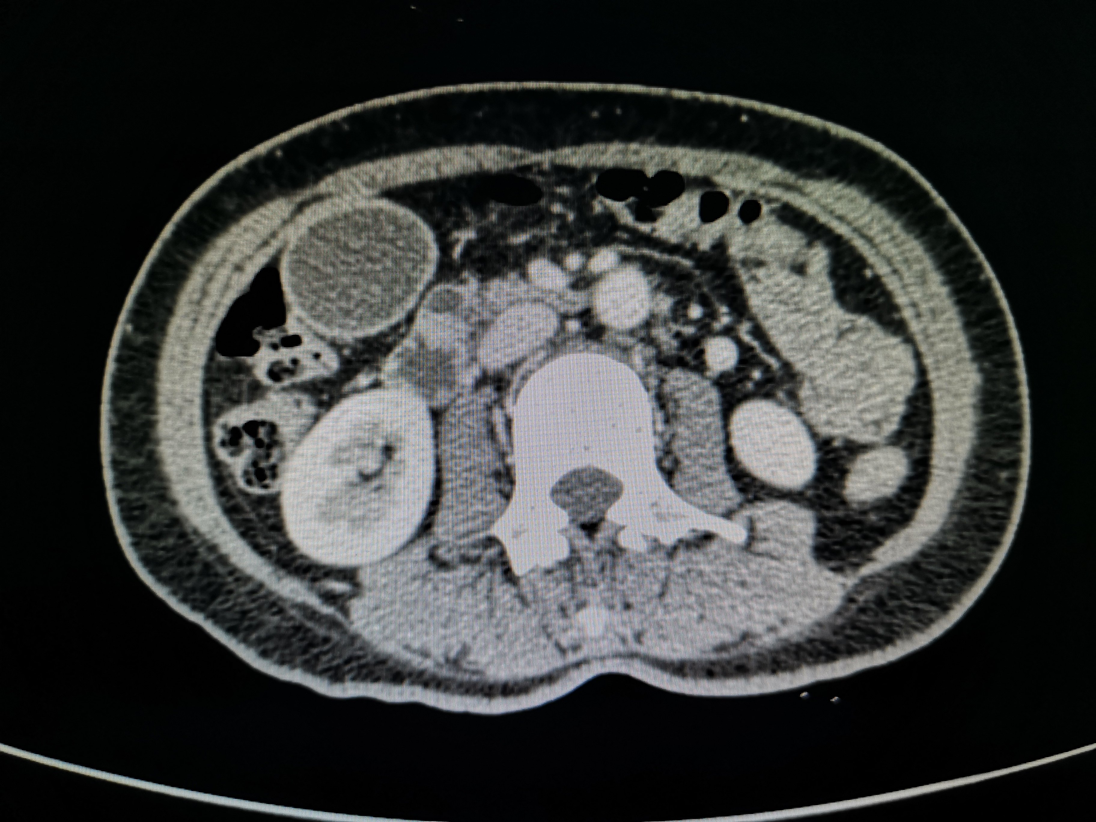 十二指肠壶腹部肿瘤图片