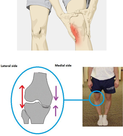 内侧间室 2.外侧间室 3.髌骨间室