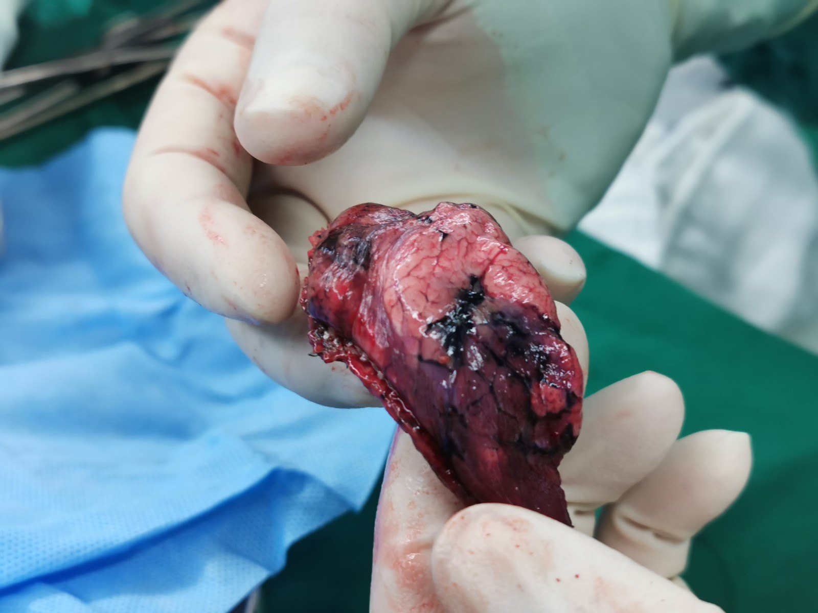 肺腺癌 手术图片
