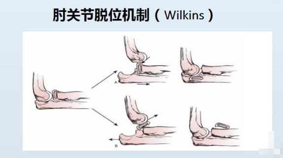 如何治療兒童橈骨頸骨折