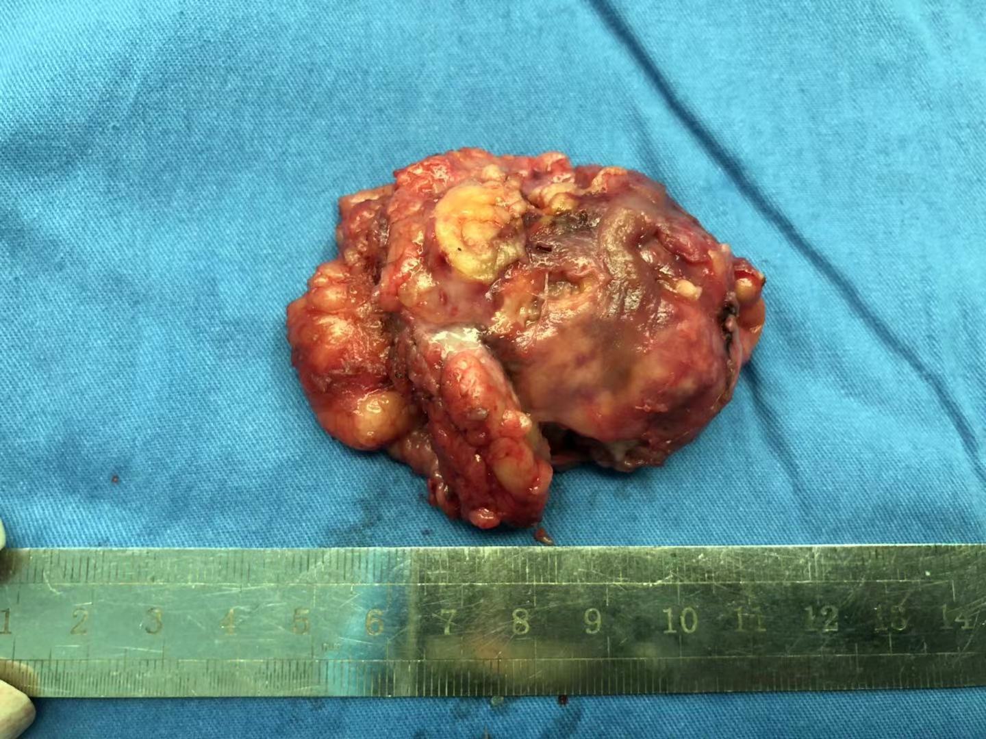 我的手术案例四肾错构瘤自发性破裂后行肾部分切除术一例