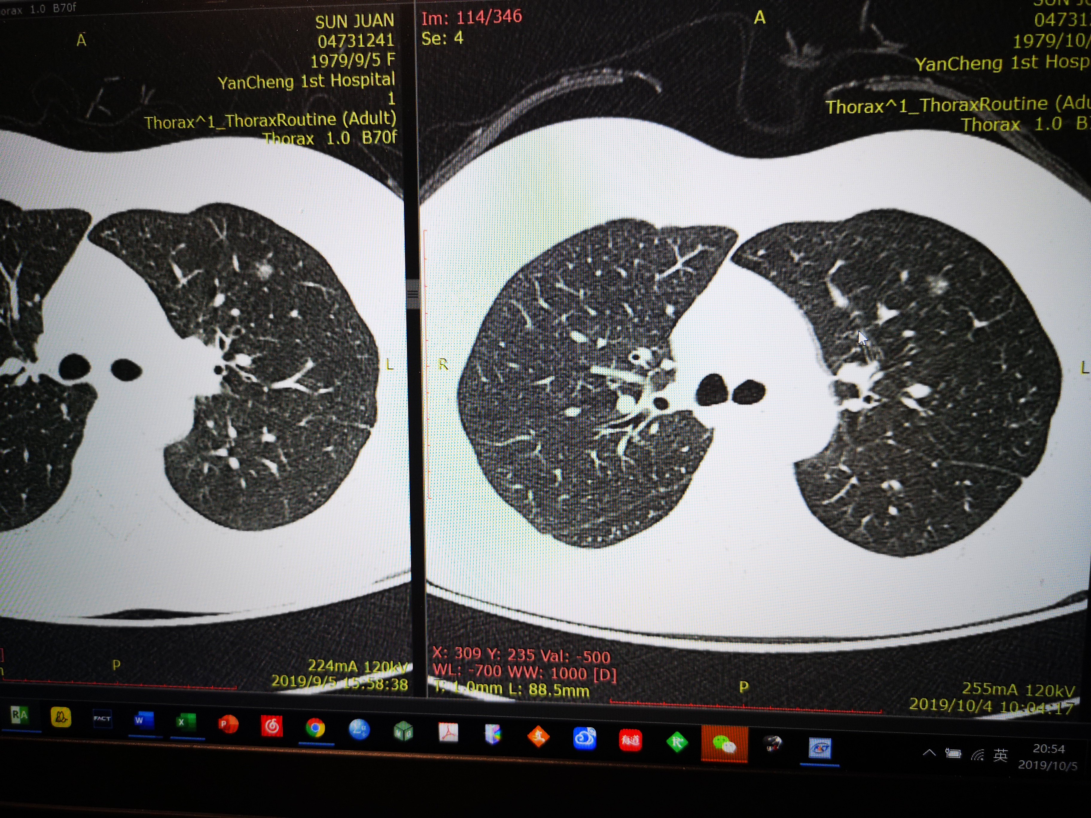 肺部5mm磨玻璃结节图片
