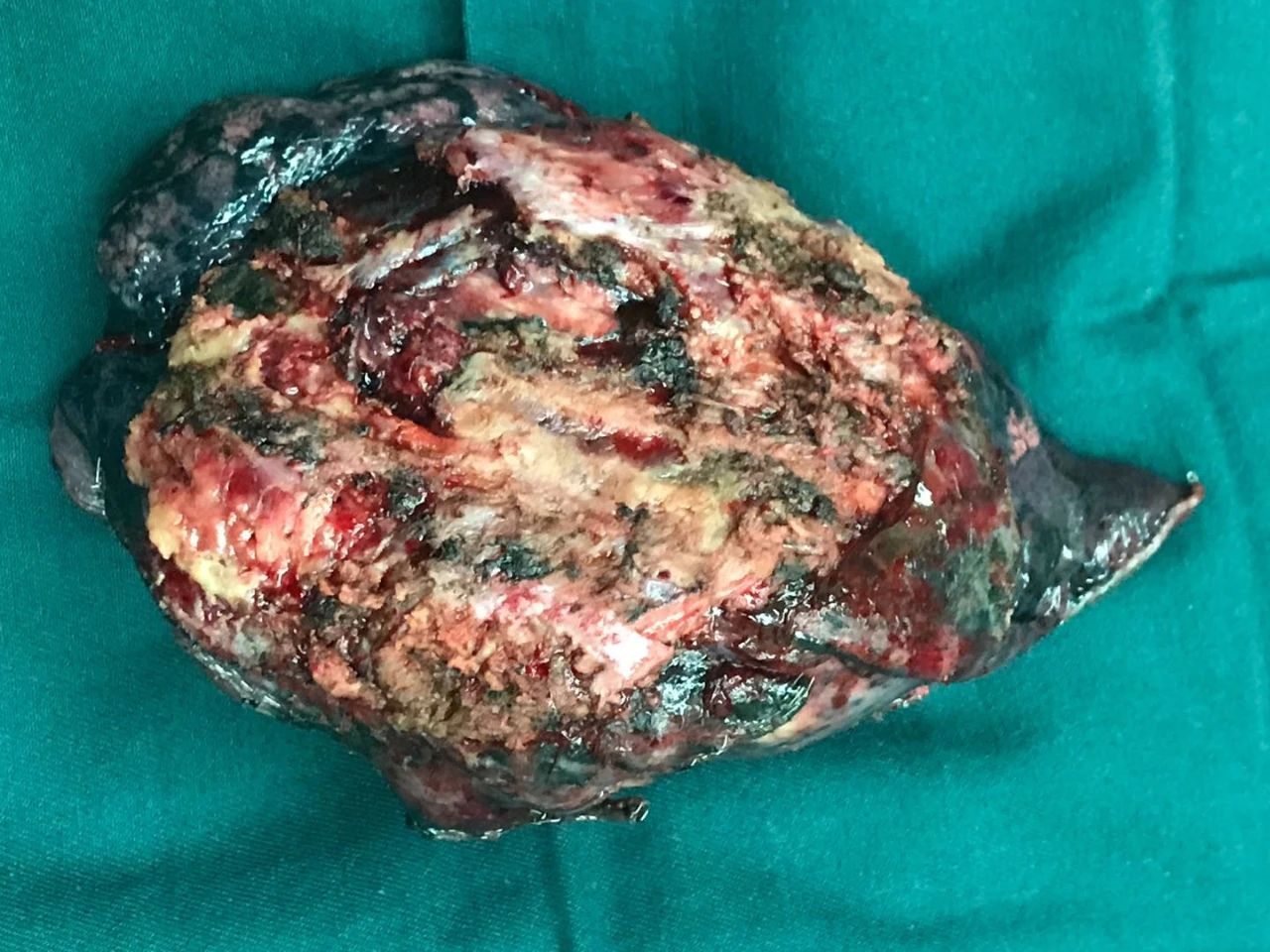 胸腔镜在胸壁受累的胸部大体积肿瘤外科治疗中的优势大的肿瘤或者又大