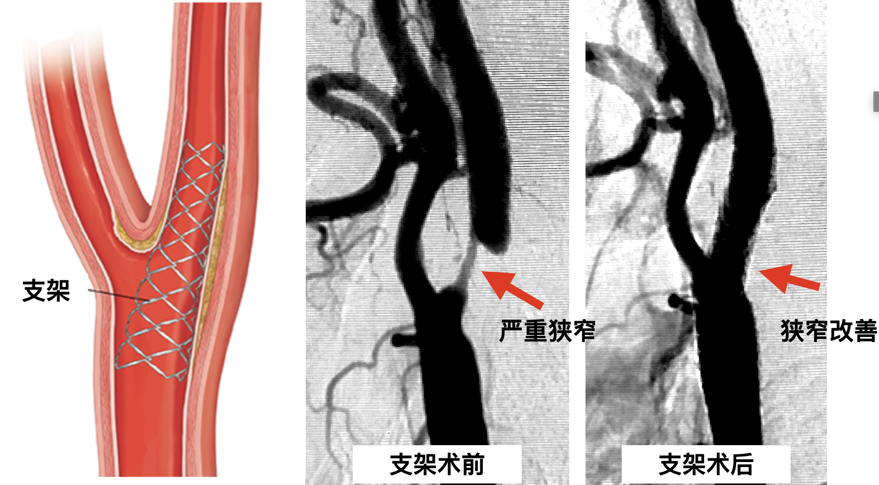 解答一个常见的问题:颈动脉支架和剥脱,哪个好?
