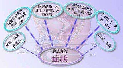 膀胱炎哪里疼图片