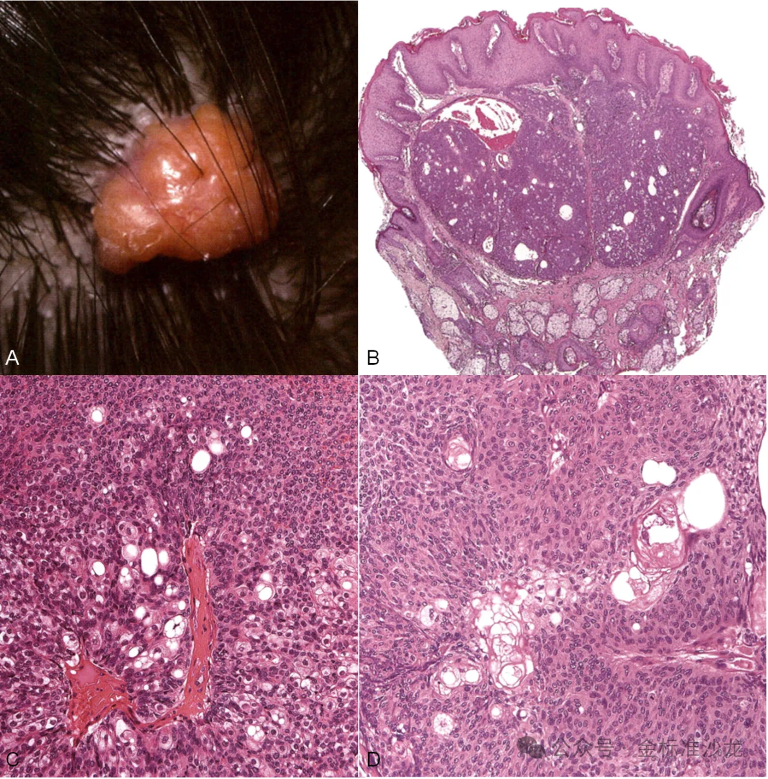 皮脂腺腺瘤图片