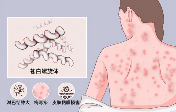 身上出现“红斑、红疹”是梅毒的症状!!!_梅毒_梅毒症状表现 - 好大夫在线
