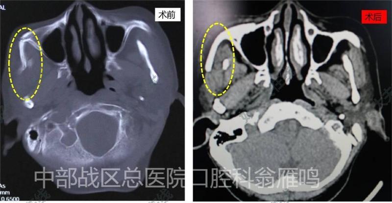 颧弓骨折 微创治疗_颧骨颧弓骨折 - 好大夫在线