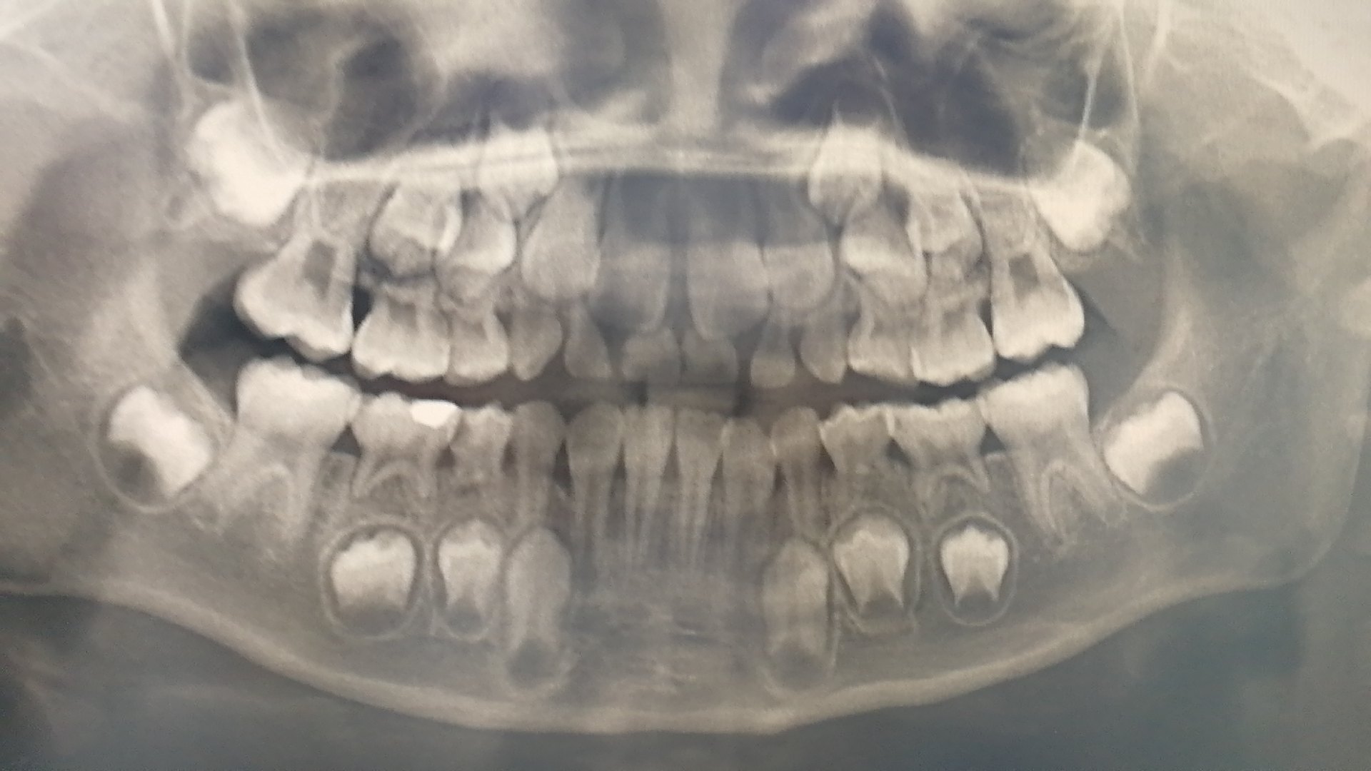 乳牙龋齿要不要治疗?_龋齿_龋齿治疗方式 - 好大夫在线