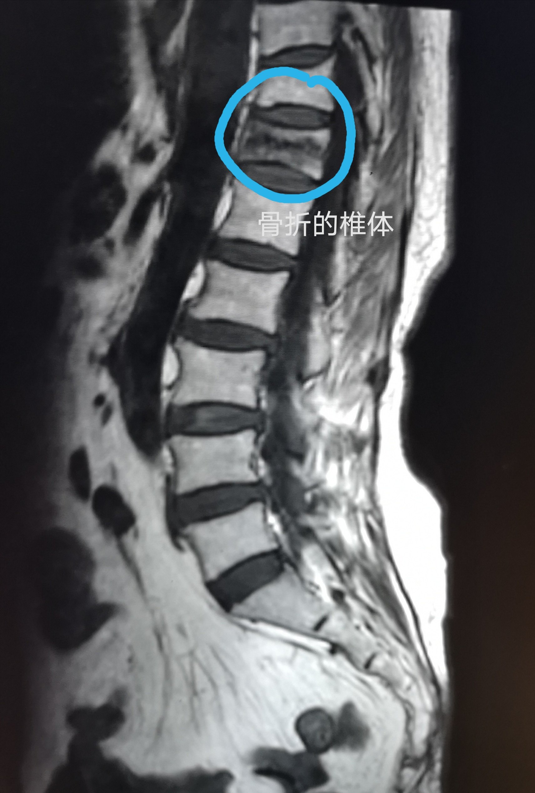 l1腰椎压缩性骨折图图片