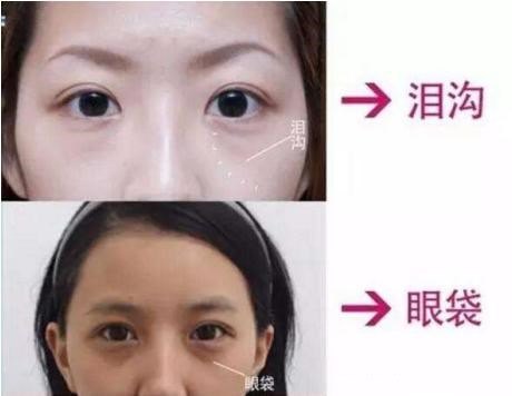 既有泪沟又有眼袋,怎么办?祝东升教授有话说_去眼袋 - 好大夫在线