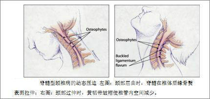 屈伸时脊髓受到的压迫.jpg