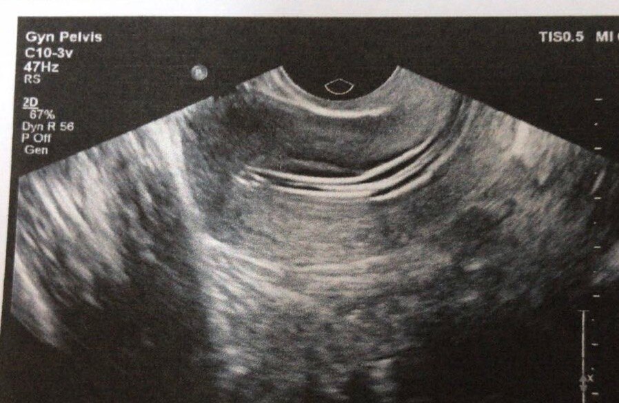 宫腔粘连三维图片图片