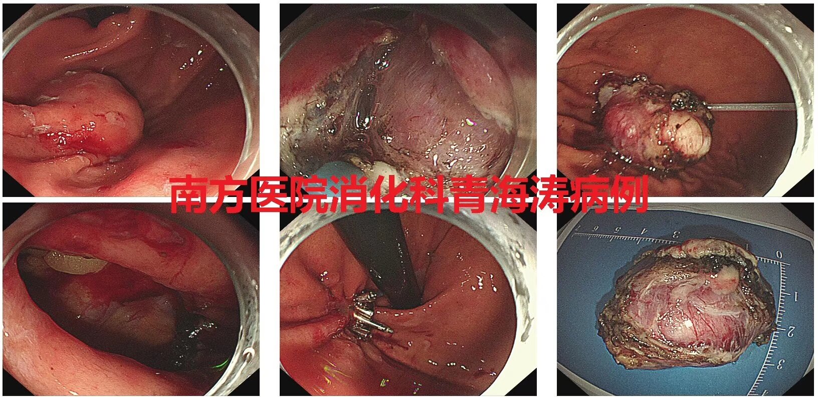 青海濤教授完成直腸多發神經內分泌腫瘤間質瘤多例內鏡切除