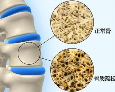 骨质疏松_介绍_发病原因_如何预防 - 好大夫在线