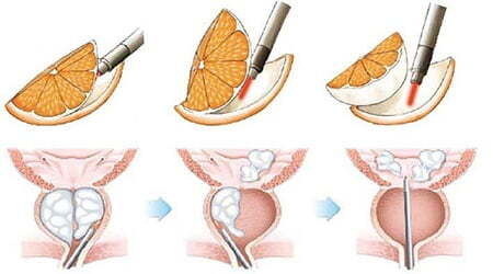 HoLEP-Holmium-laser-enucleation-of-the-prostate.jpg