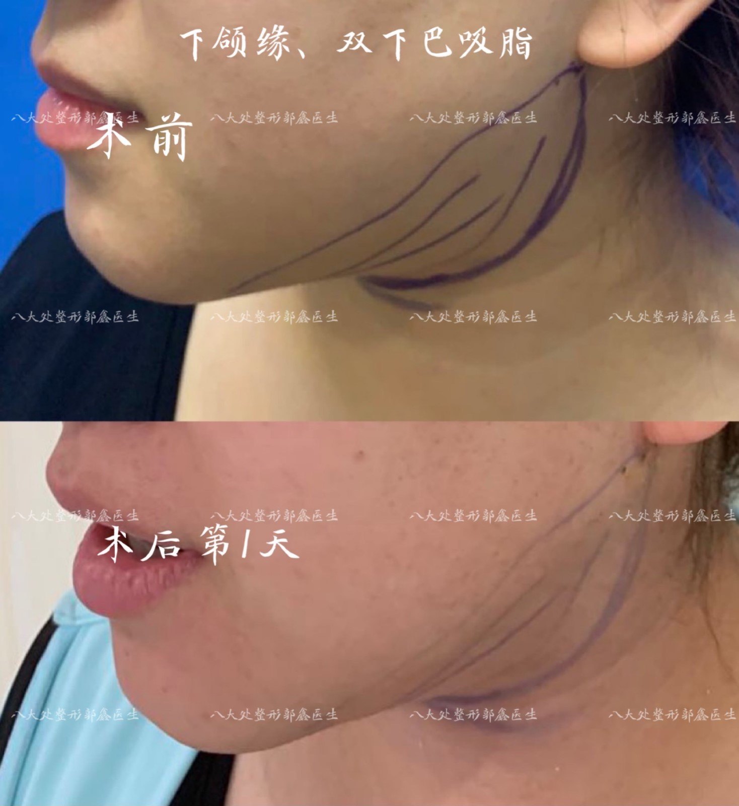 面部,双下巴,下颌缘吸脂案例(自然胖,非修复类)(郭鑫医生)_面部吸脂
